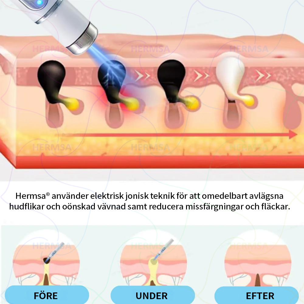 Hermsa® ikke-invasiv laserpointer - fjernelse af modermærker og vorter